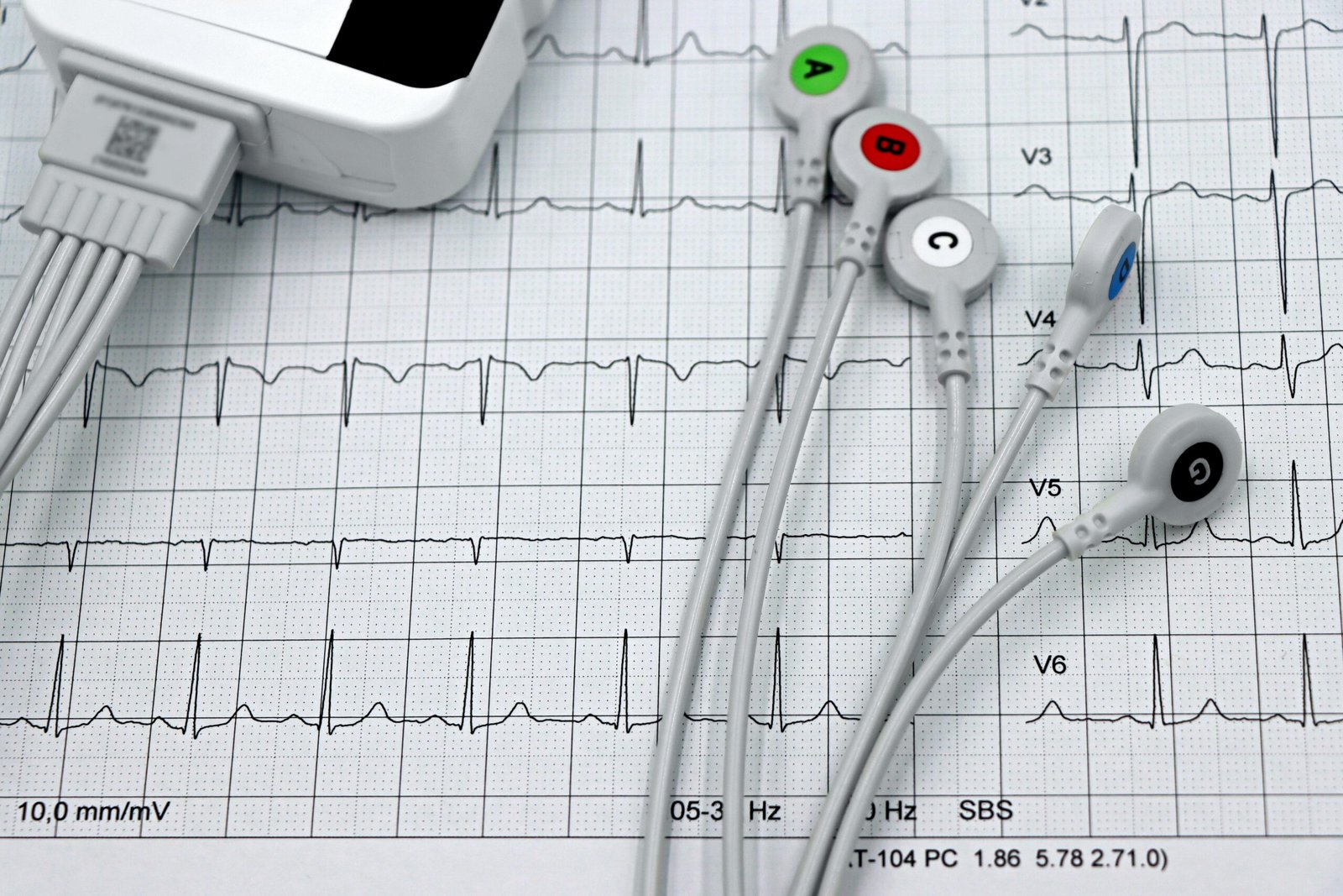 Close-up of an electrocardiogram (ECG) printout with several labeled ECG electrode leads (A–G) connected to a monitoring device, displaying clear heart rhythm waveforms across multiple channels.