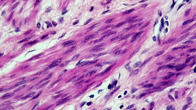 Breaking New Ground in MPNST Cancer Treatment: Targeting the Pentose Phosphate Pathway
