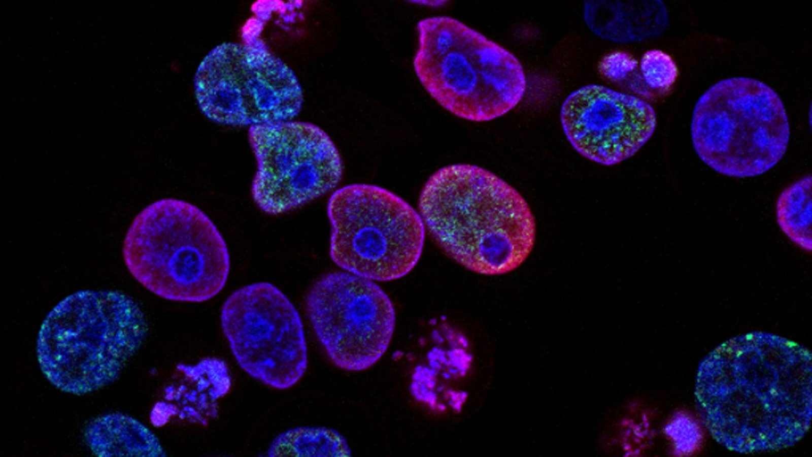 Human cancer cells